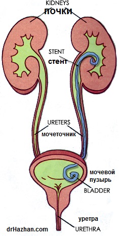 Стент мочеточника отзывы